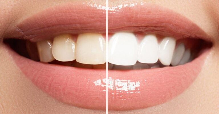 6 Tips for Transforming Your Look with Teeth Whitening